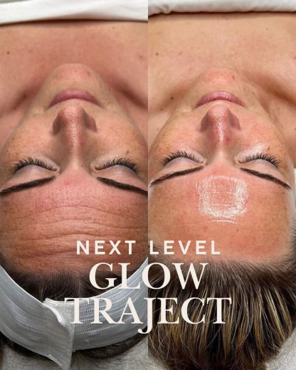 Blush Next Level Glow Traject - Afbeelding 3