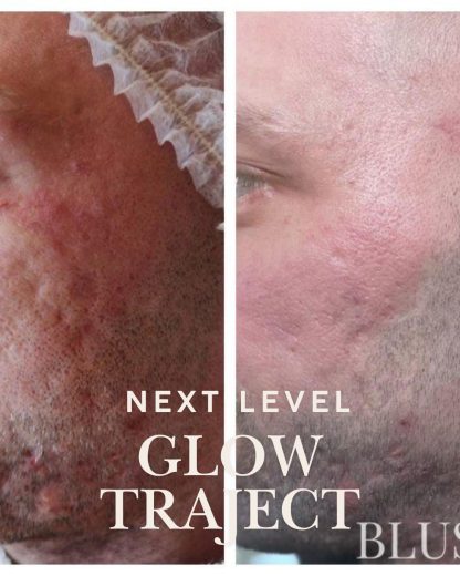 Blush Next Level Glow Traject - Afbeelding 6